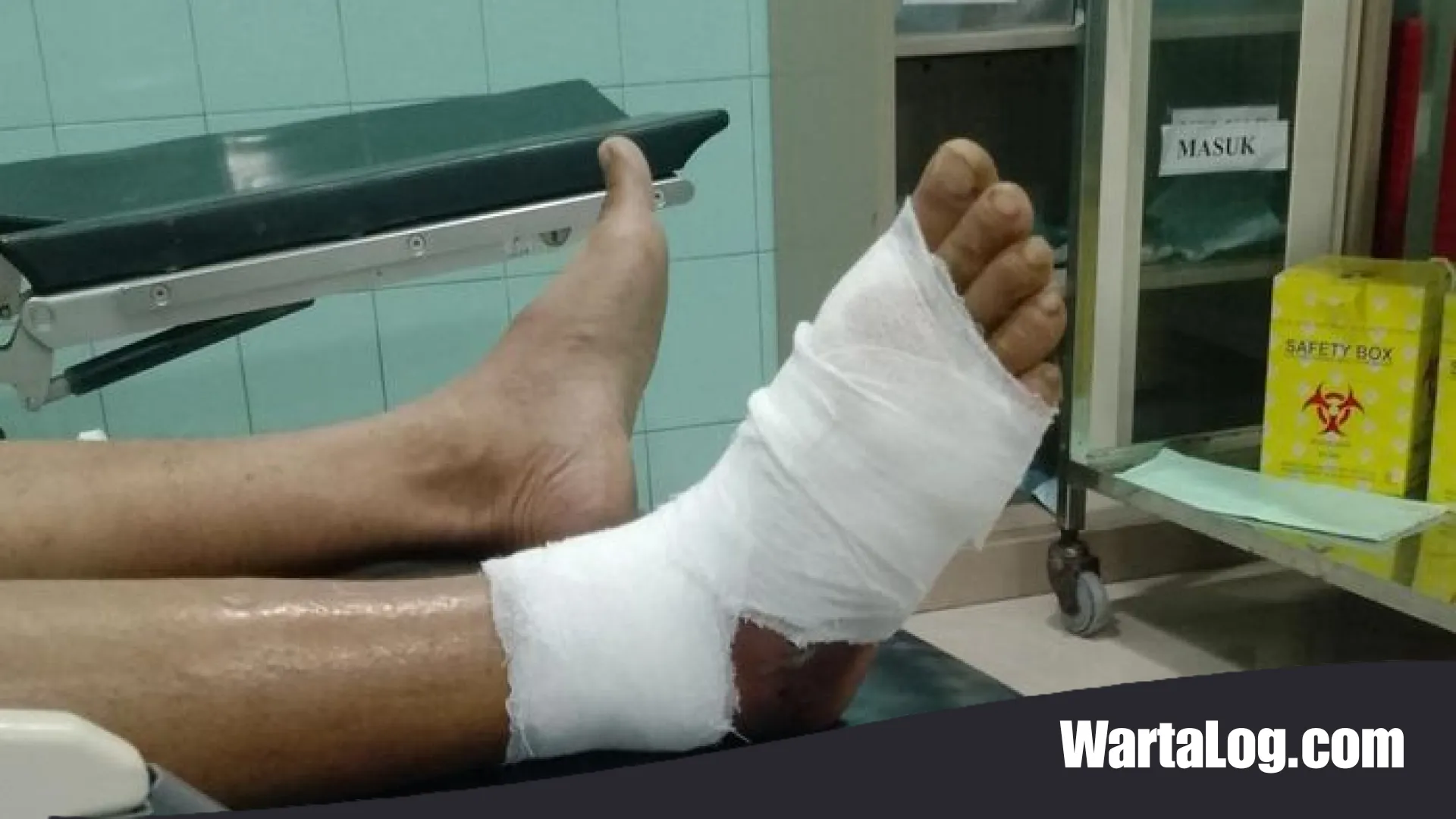 Kaki Melepuh Akibat Gigitan Ular Viper, Seorang Pria di Brebes Berjuang Lawan Bisa dan Biaya Medis